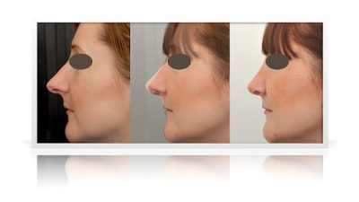 Discover The Best Liquid Rhinoplasty Treatment For You